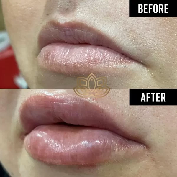 Lip Augmentation with Hyaluronic Acid