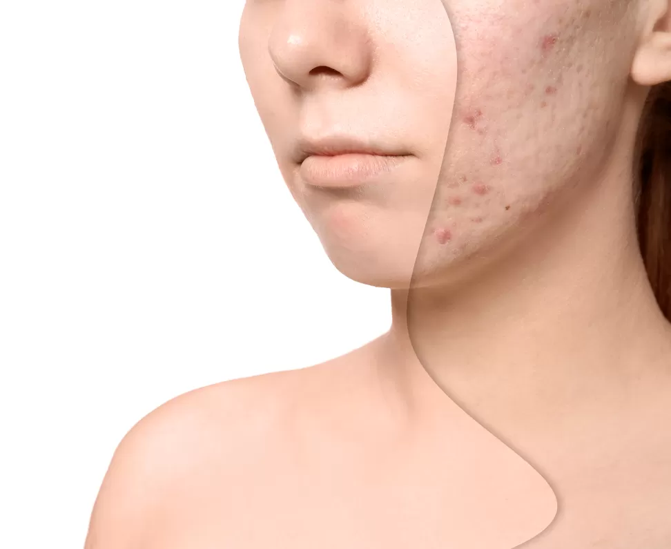 Microneedling