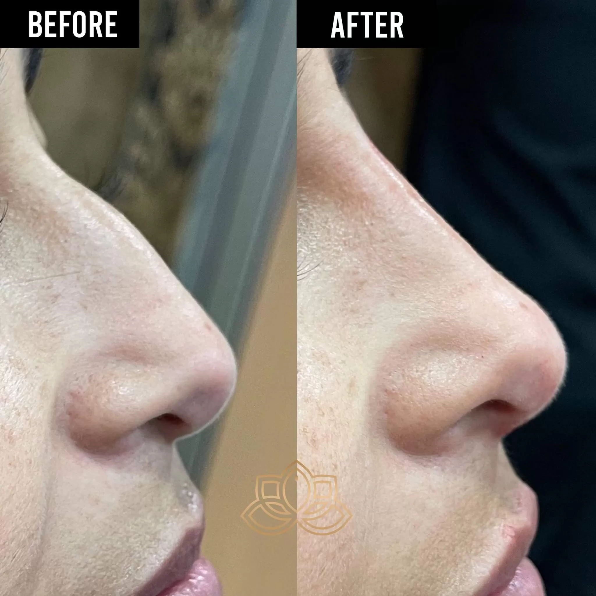 Facial fillers treatment at Vive Medical Spa
