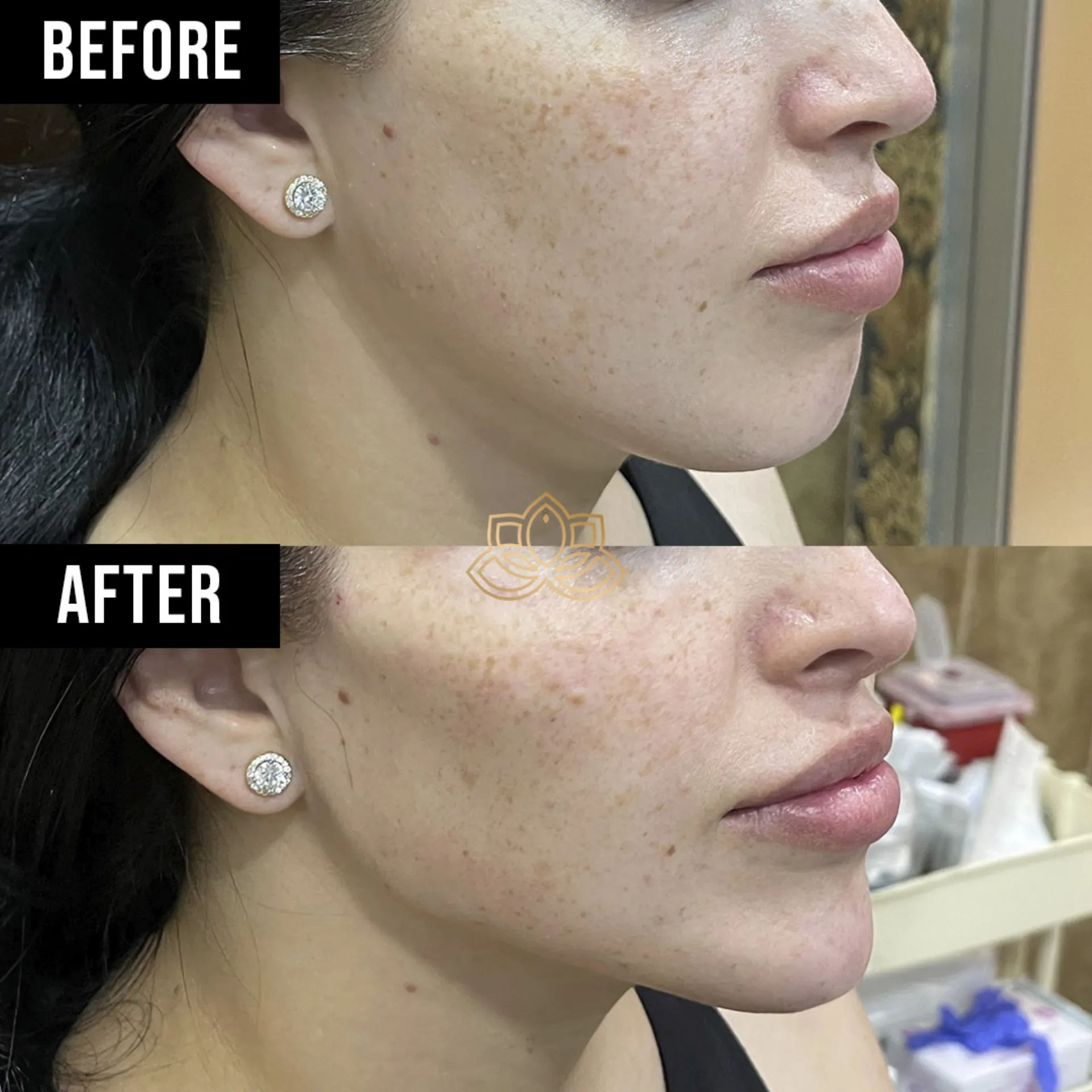 Jaw Contouring after