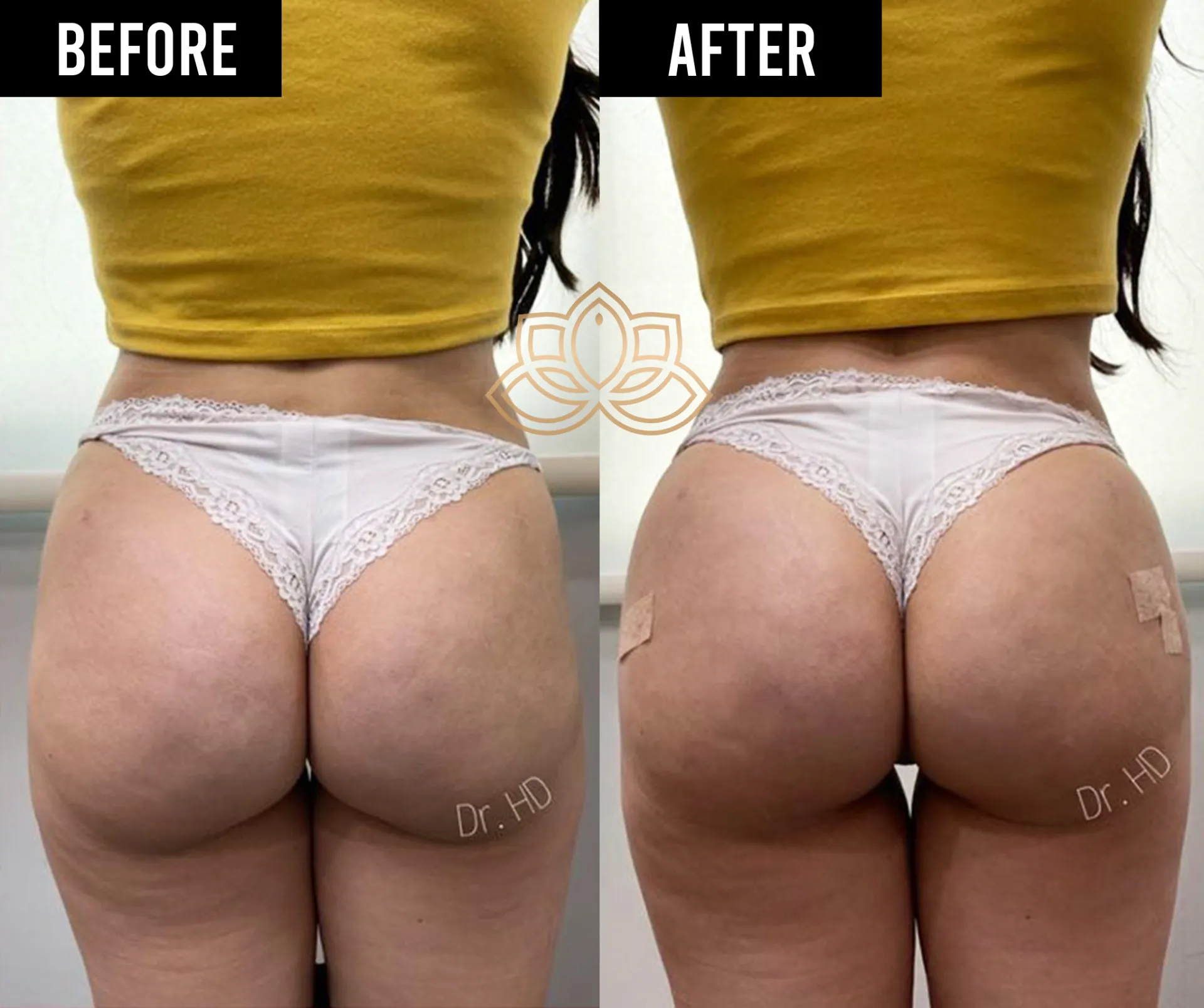 Butt Filler before