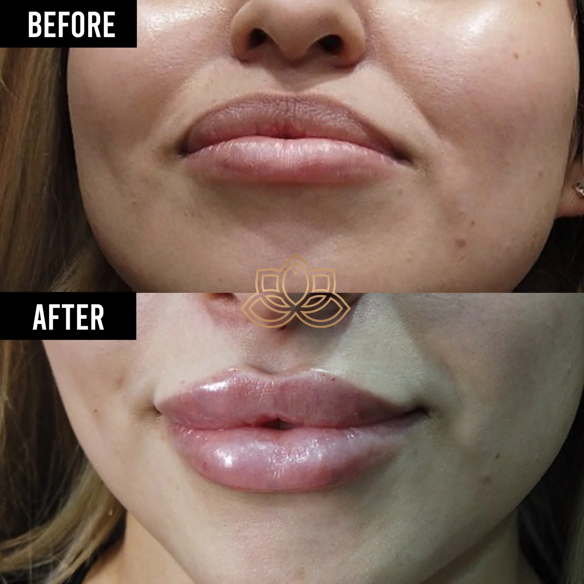 Lip Filler after