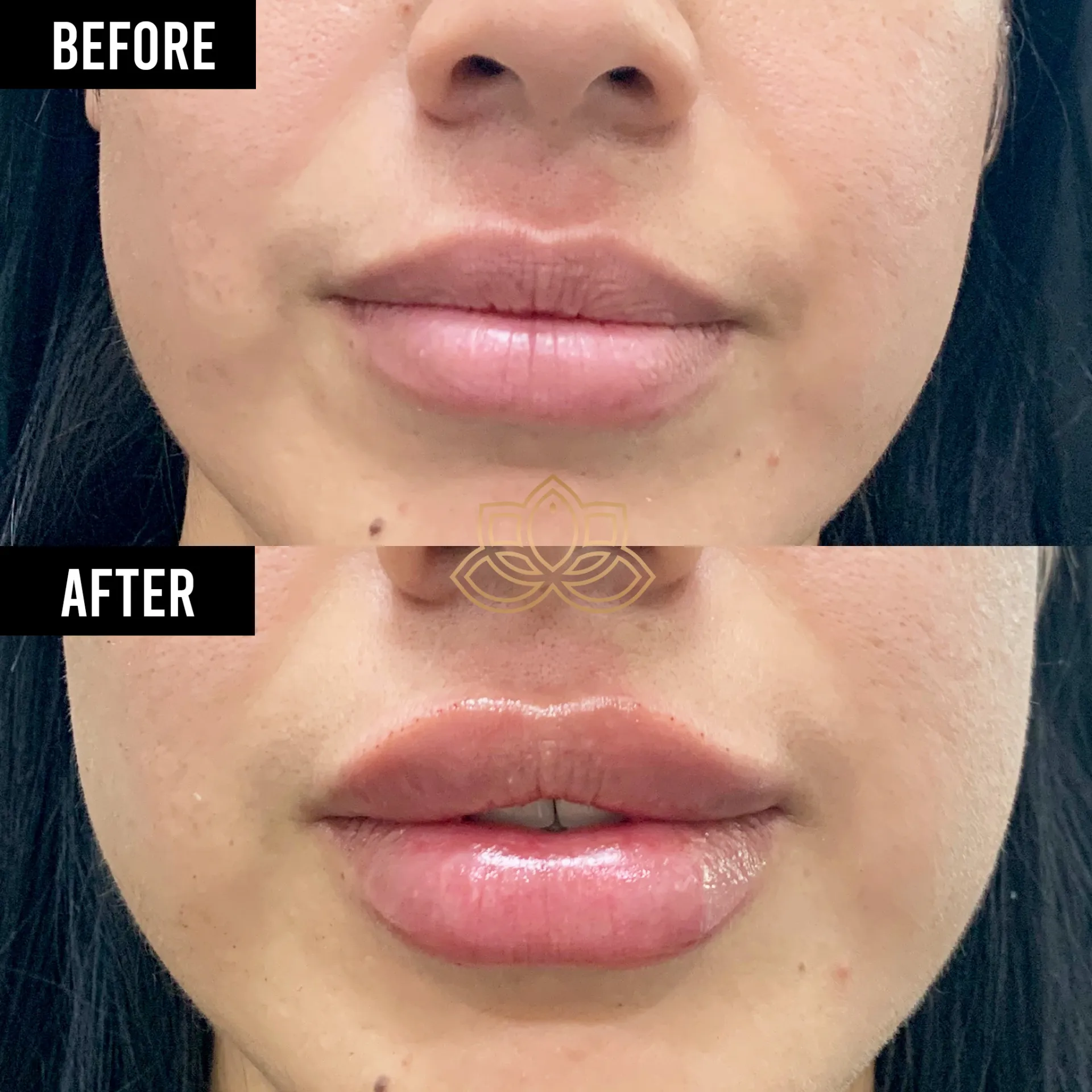 Lip Filler before