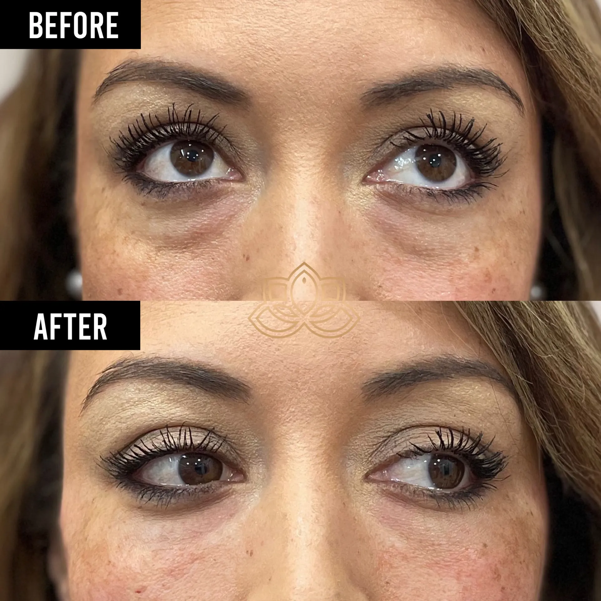 Eye Bags before