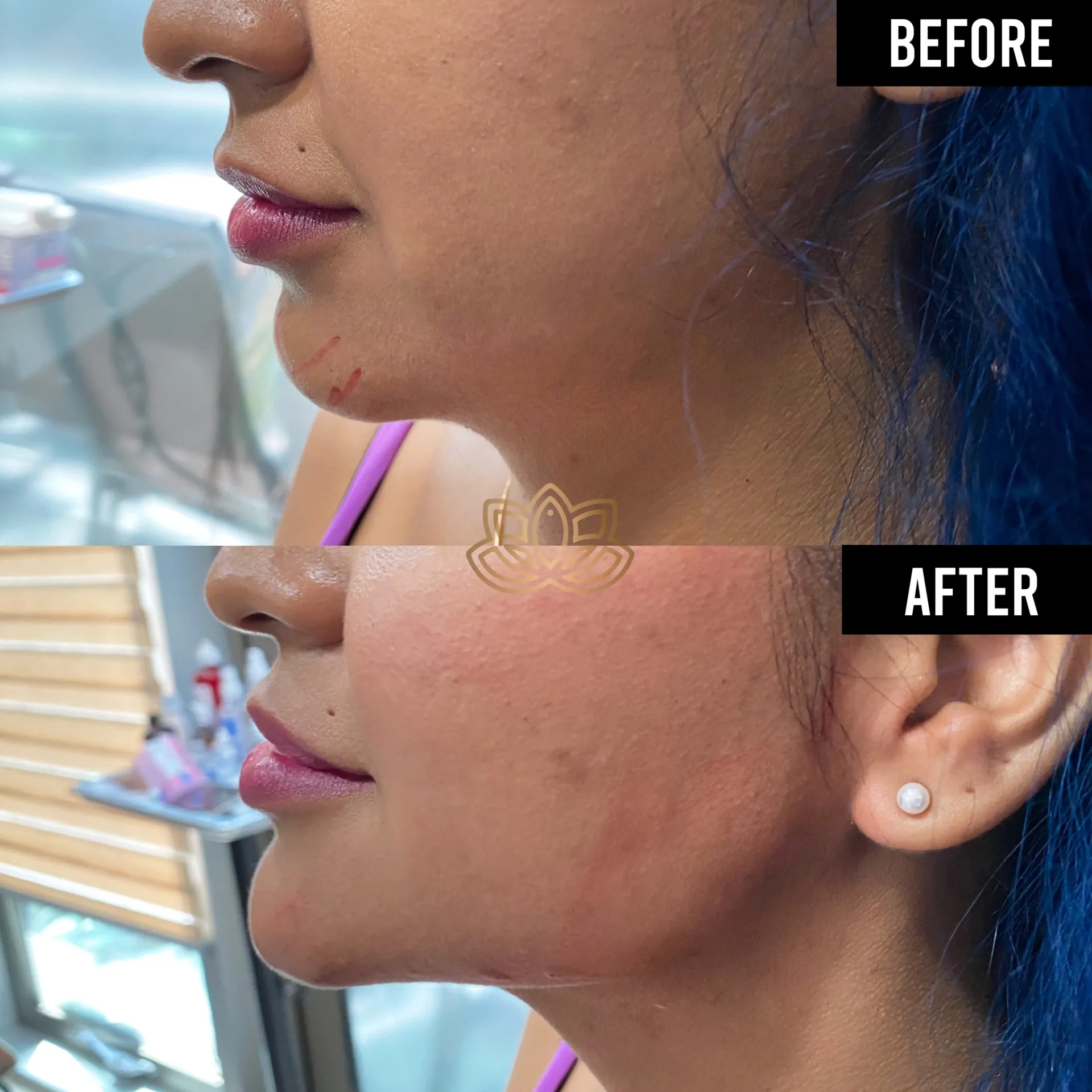 Jaw Contouring before