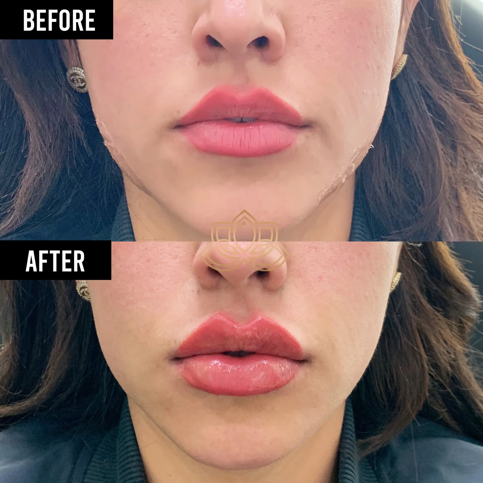 Lip Filler before