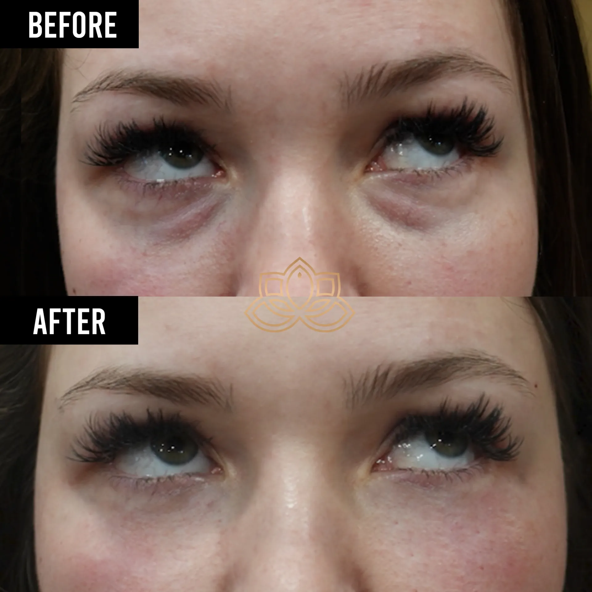 Eye Bags after