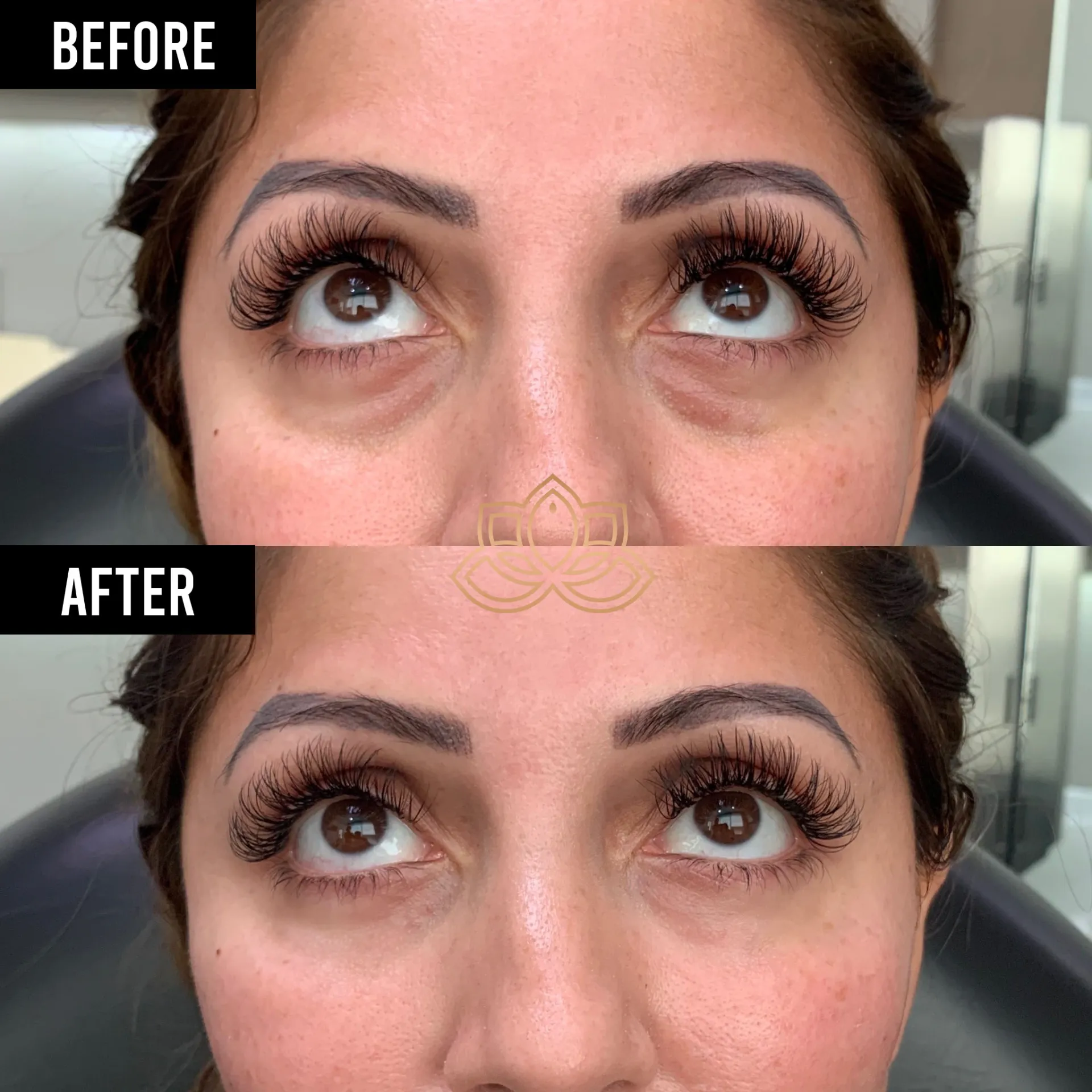Eye Bags before