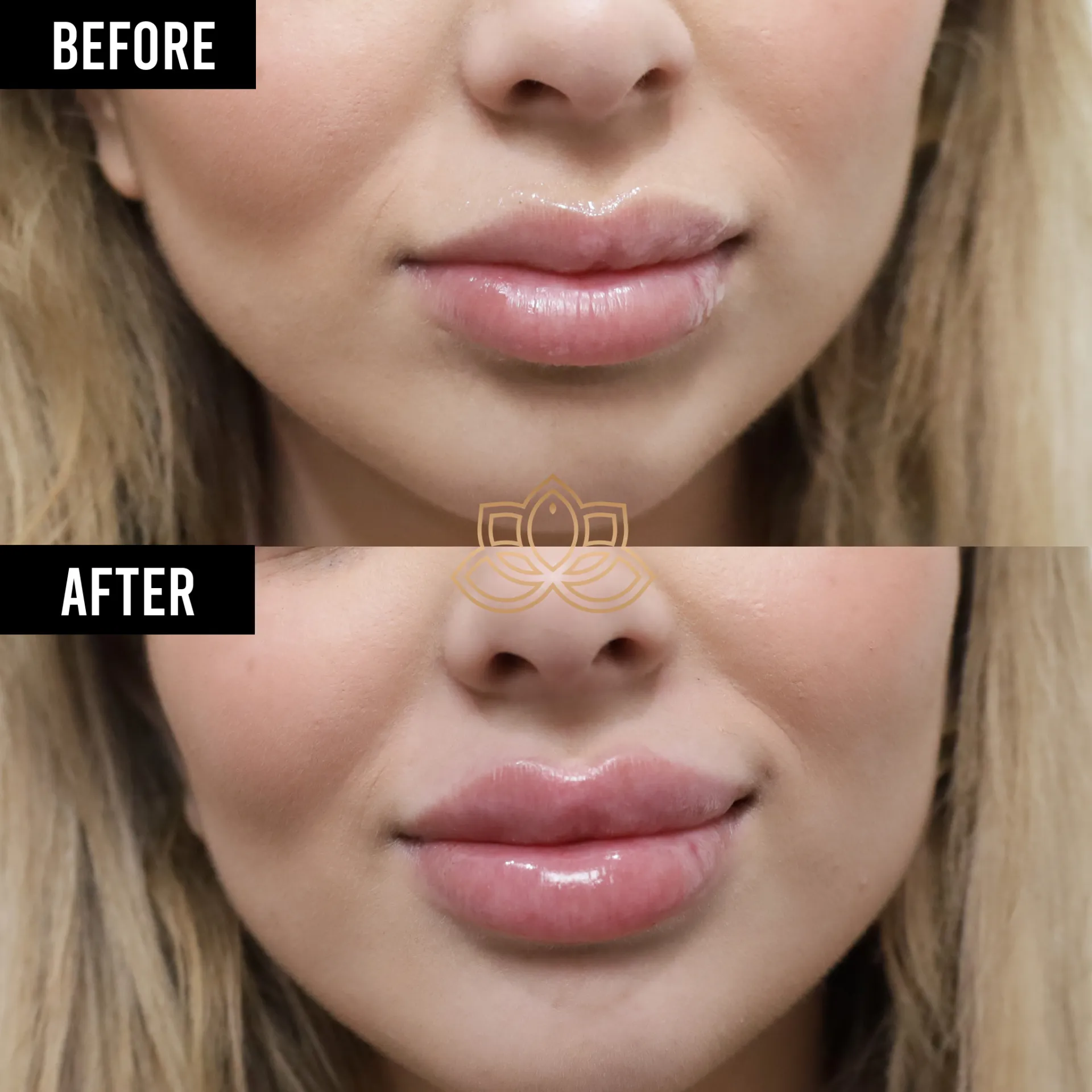 Lip Filler before