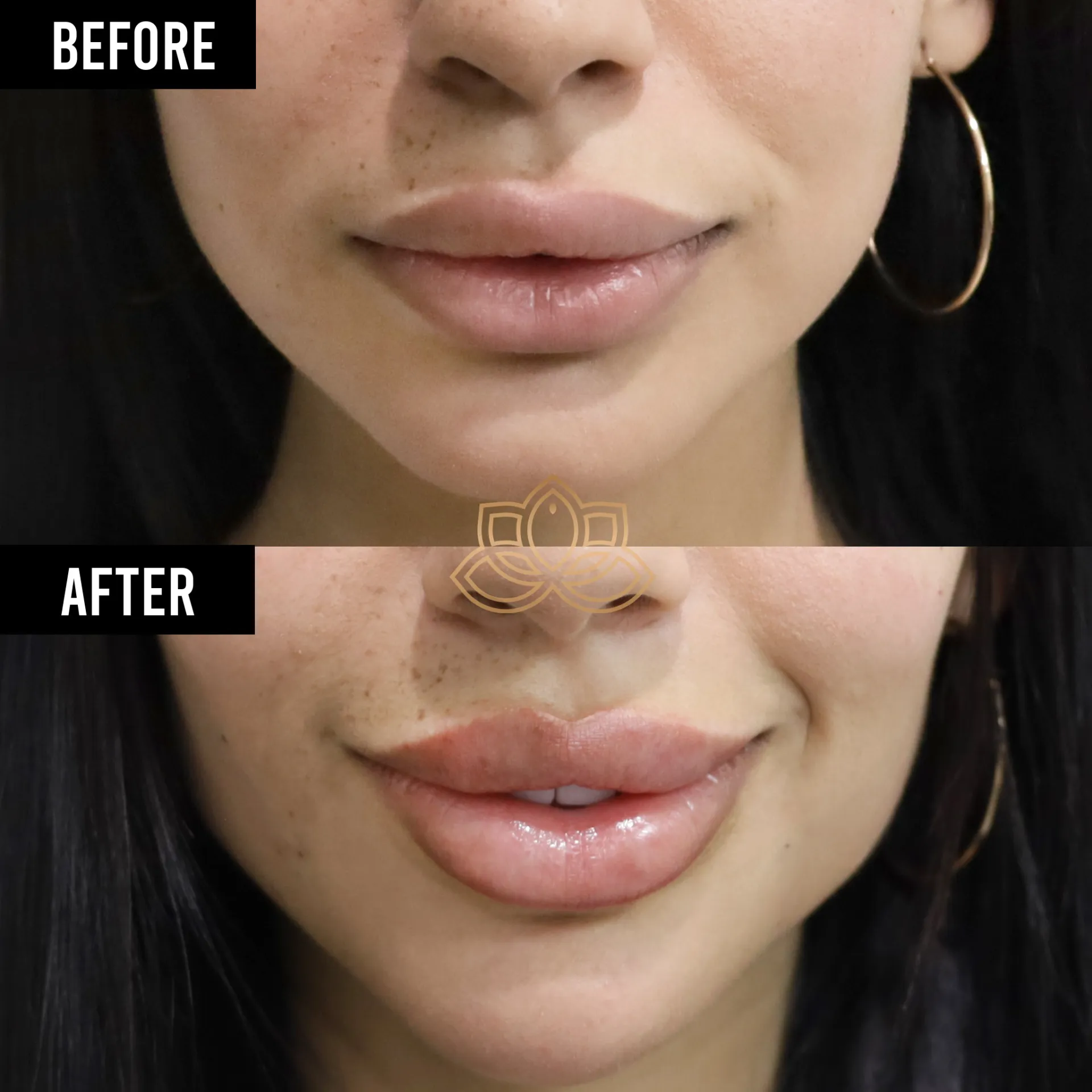 Lip Filler after