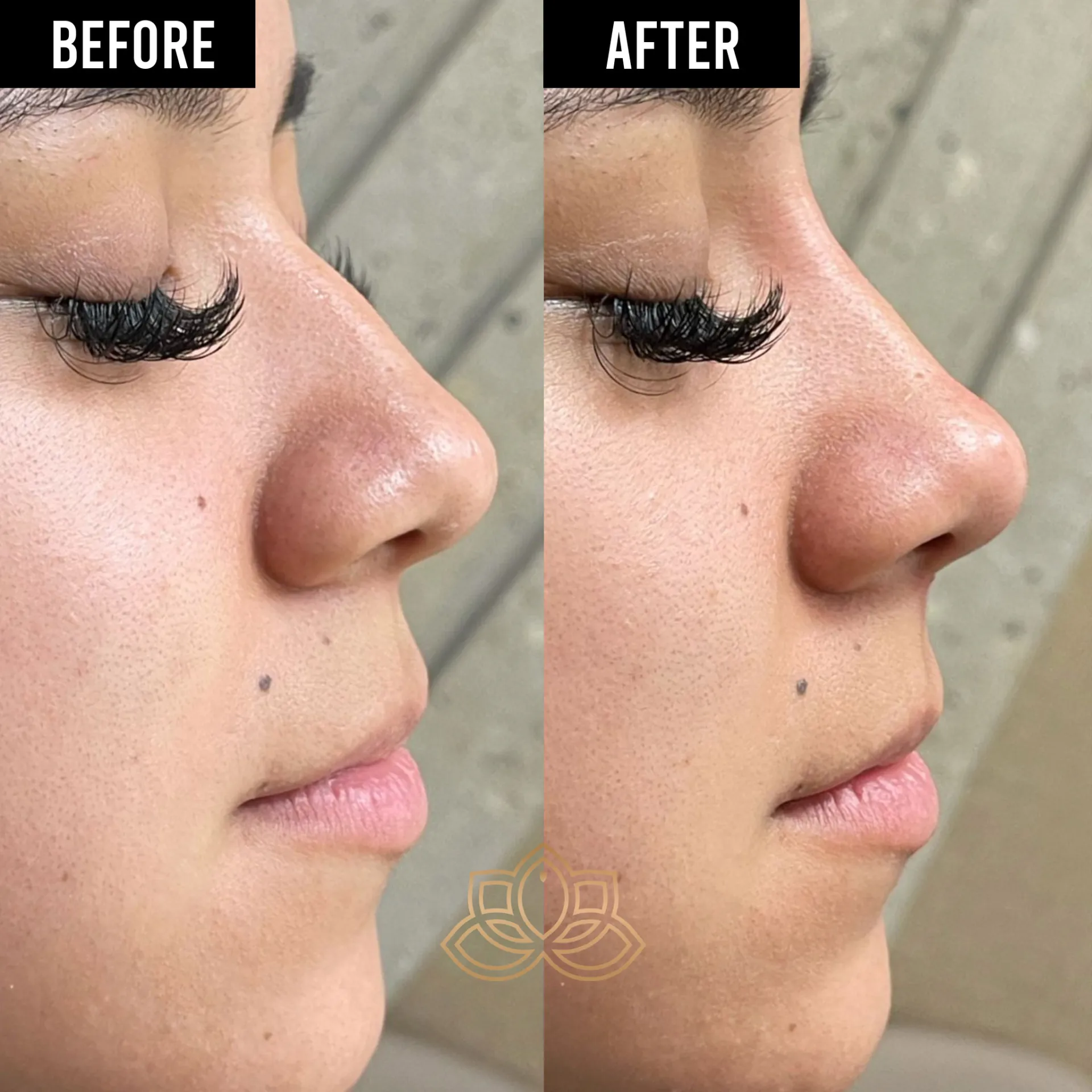 Nose Filler before