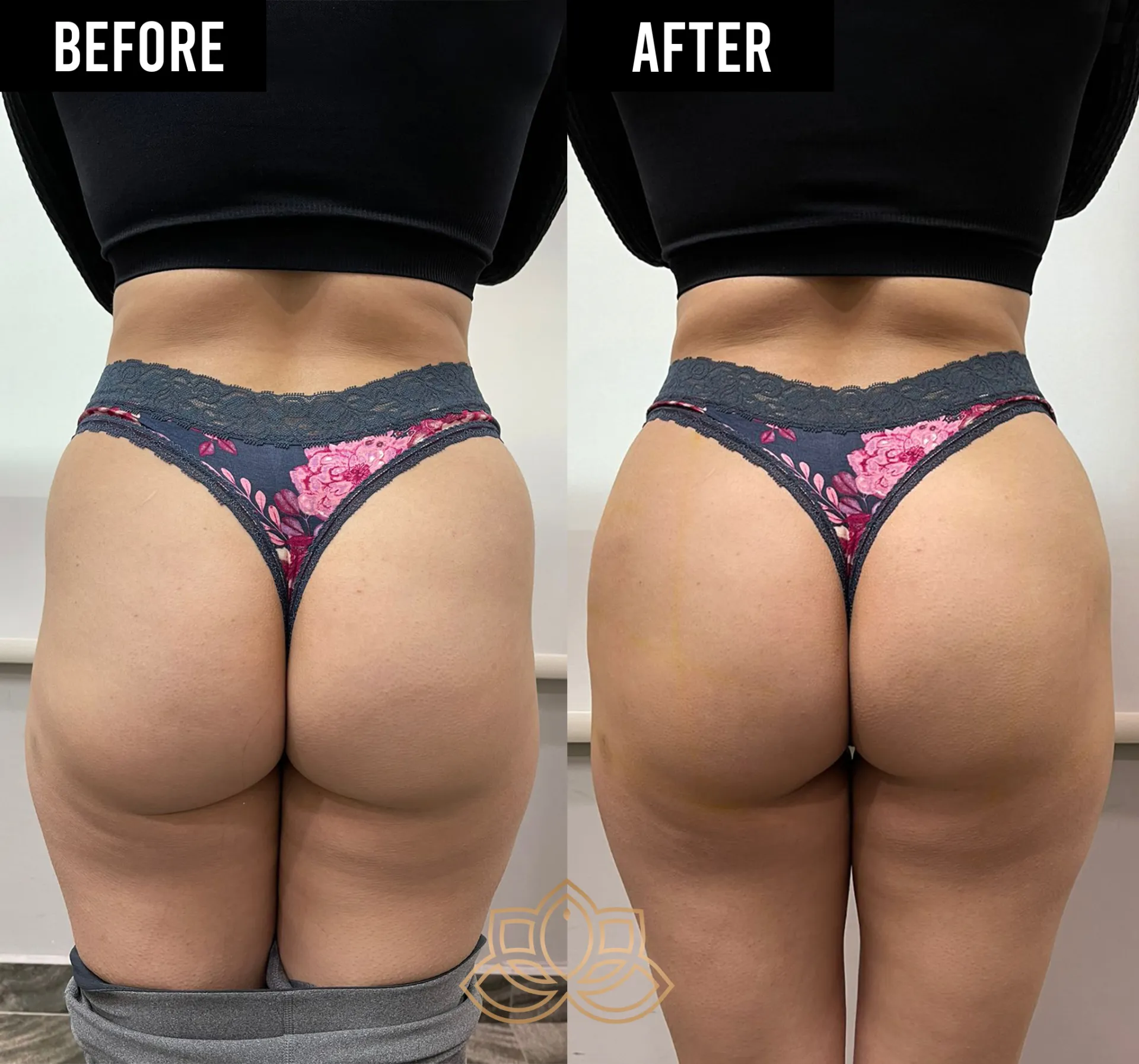 Butt Filler before