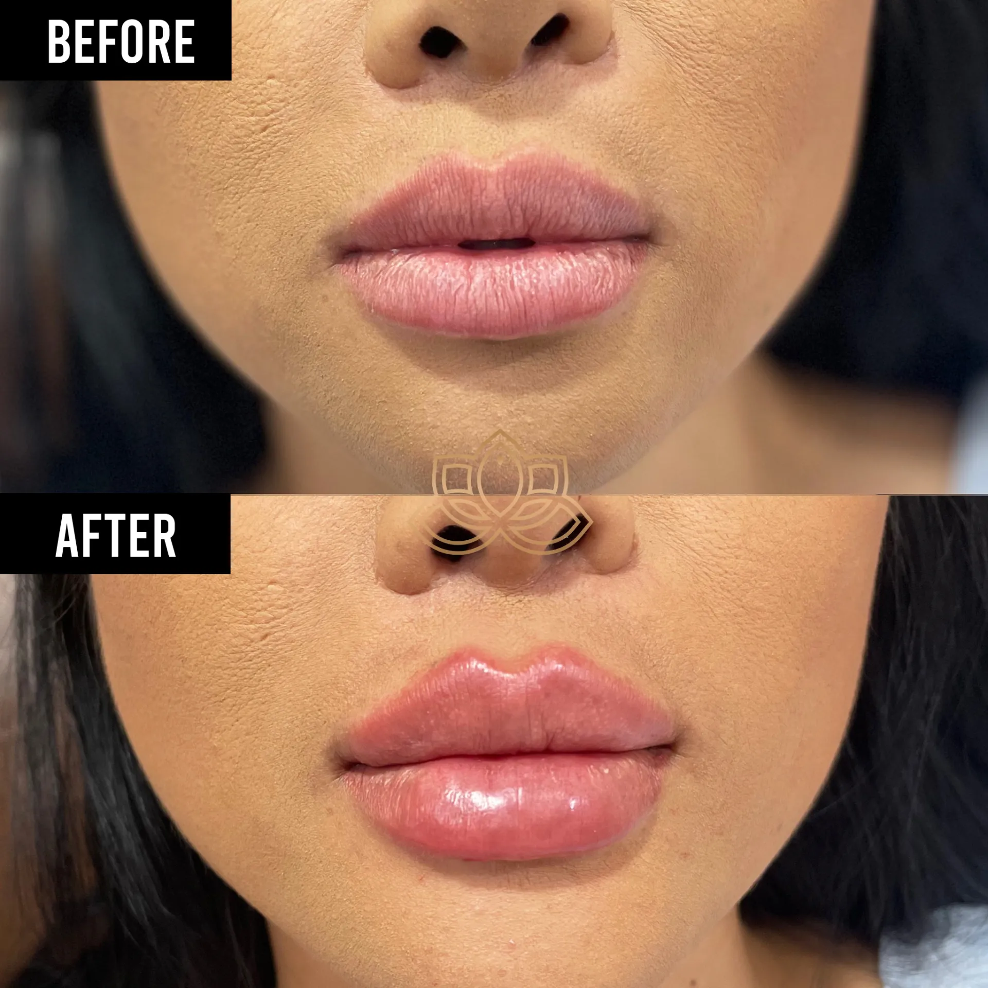 Lip Filler after
