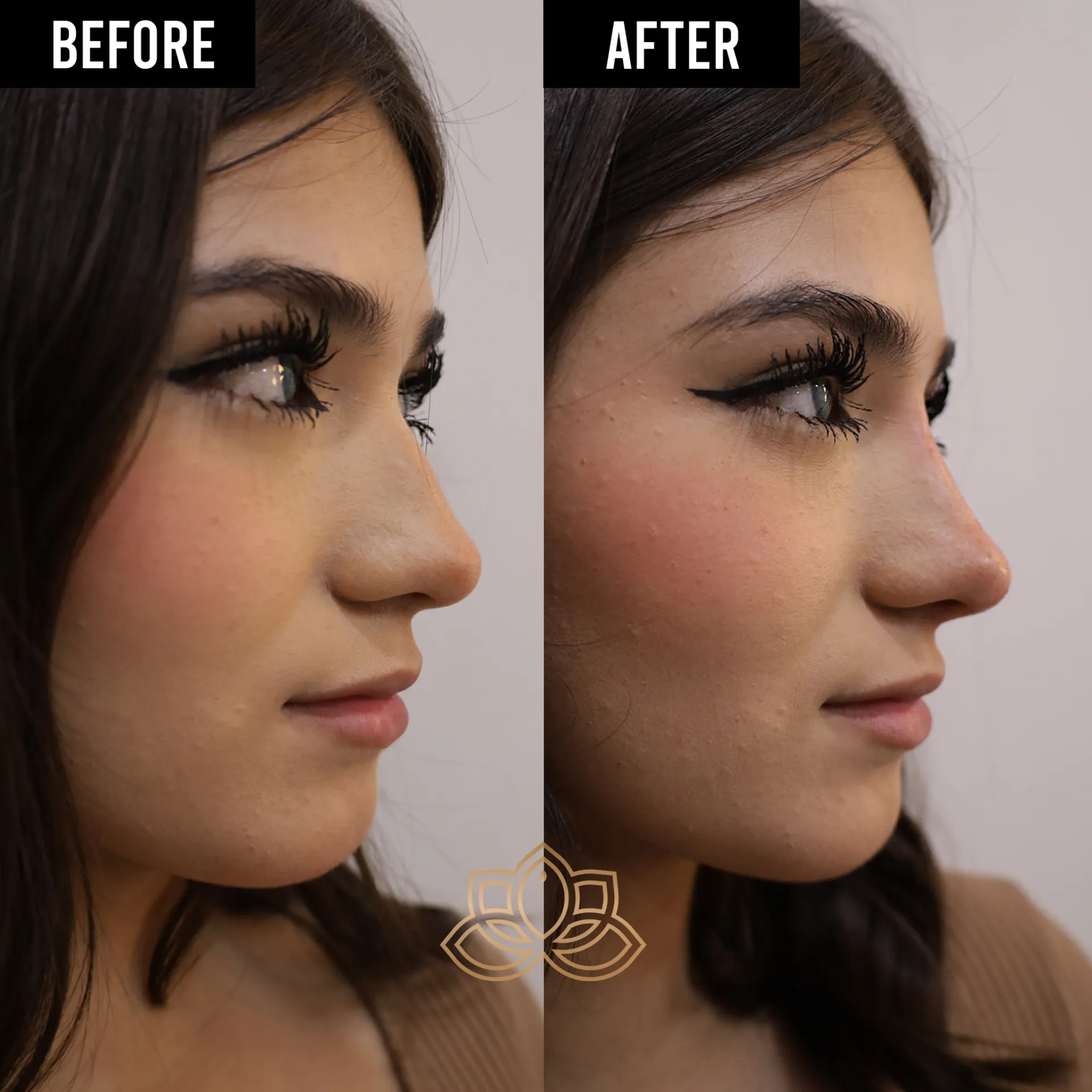 Nose Filler after