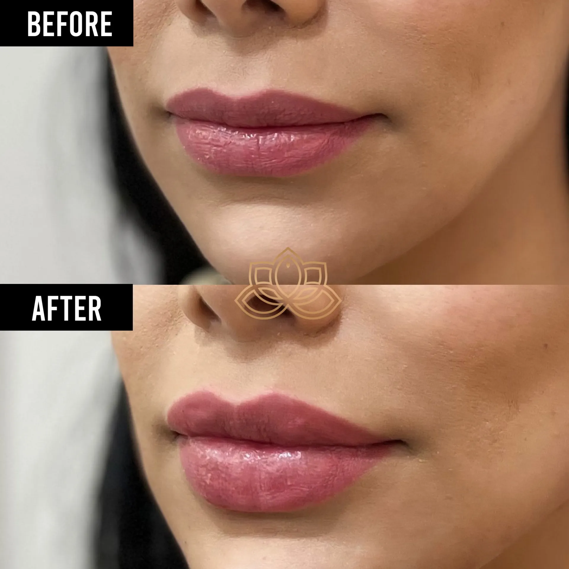 Lip Filler before