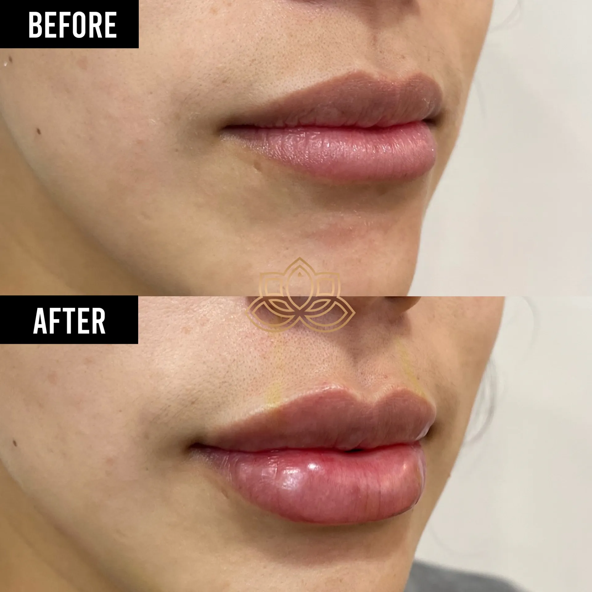 Lip Filler after