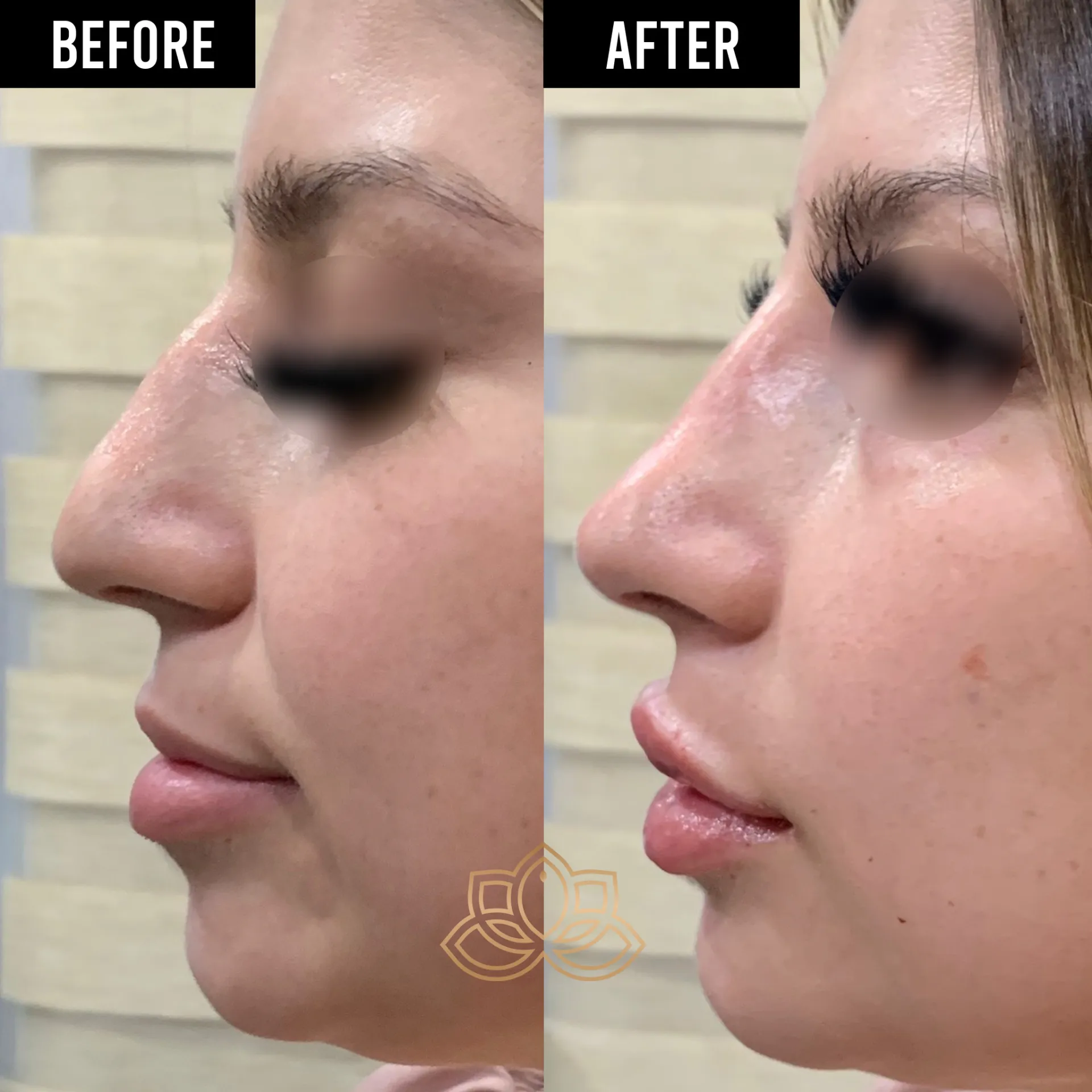 Nose Filler before