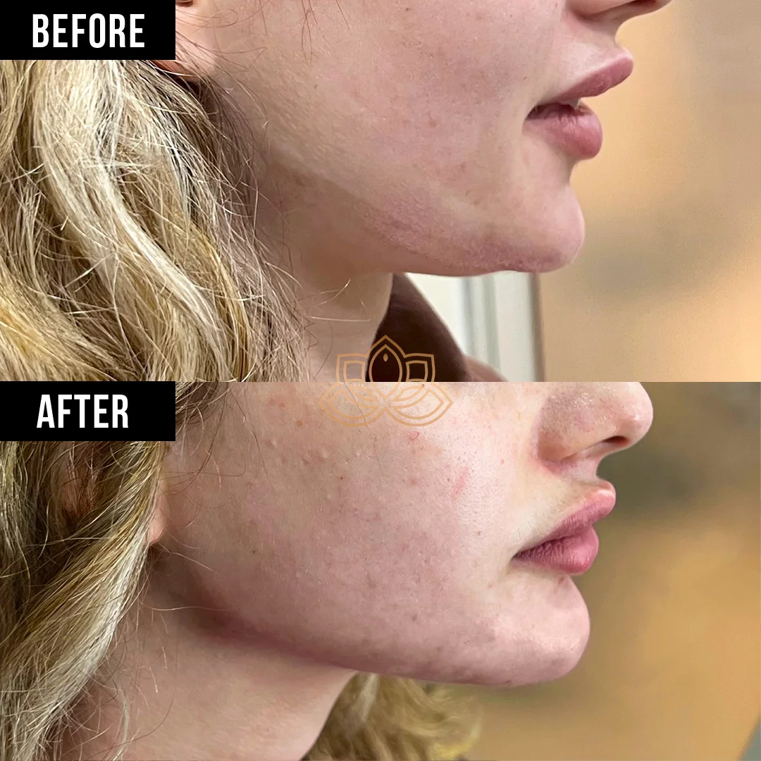Jaw Contouring before
