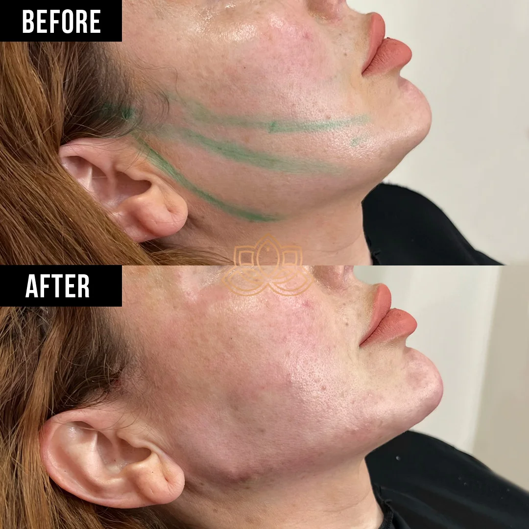 Jaw Contouring after