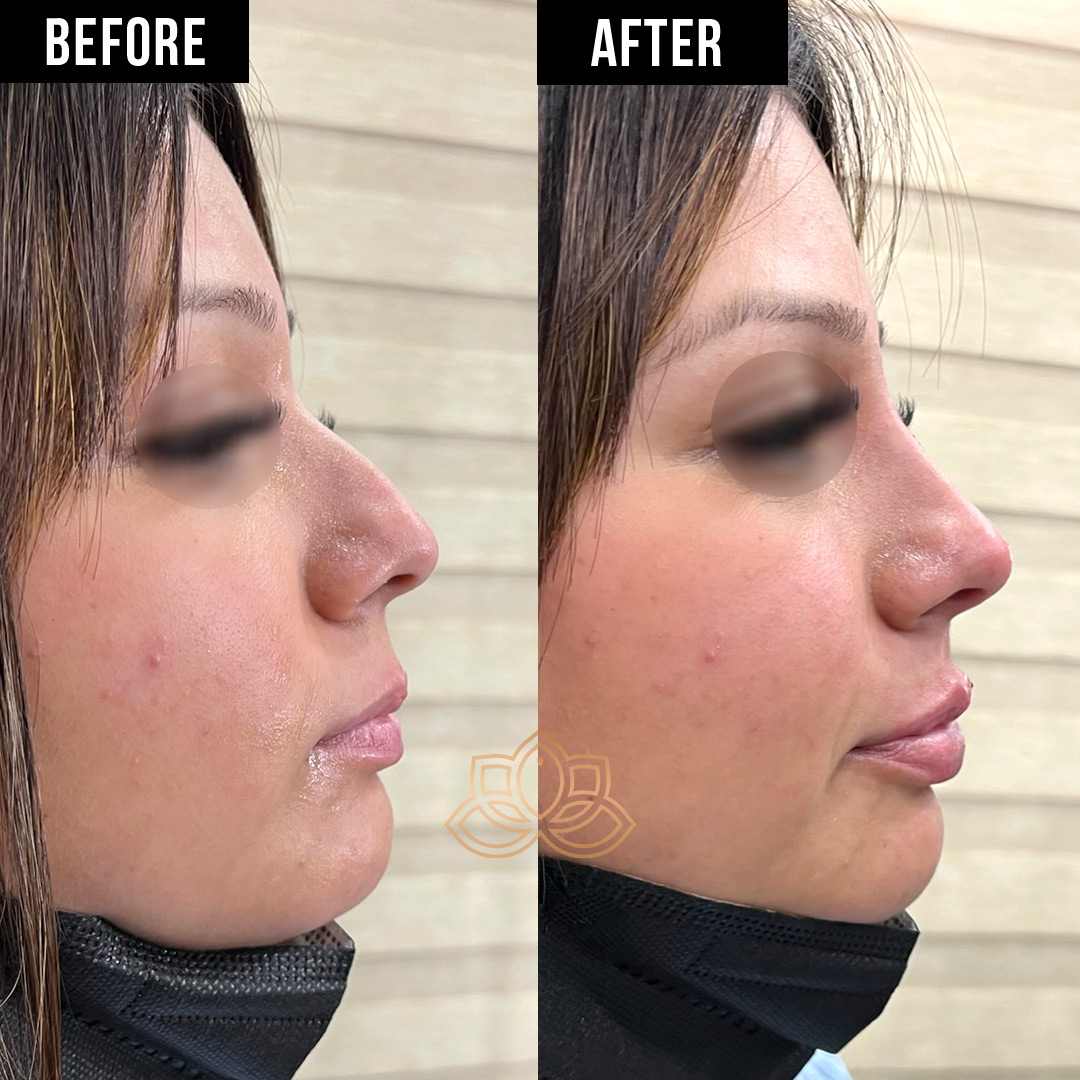 Nose Filler after