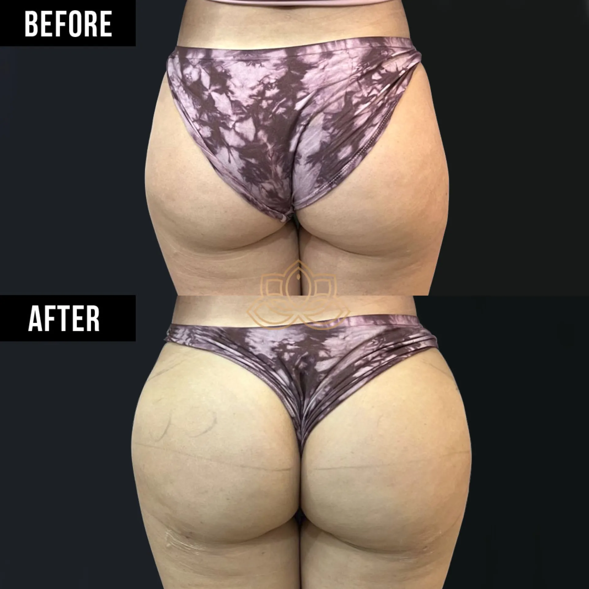 Butt Filler after