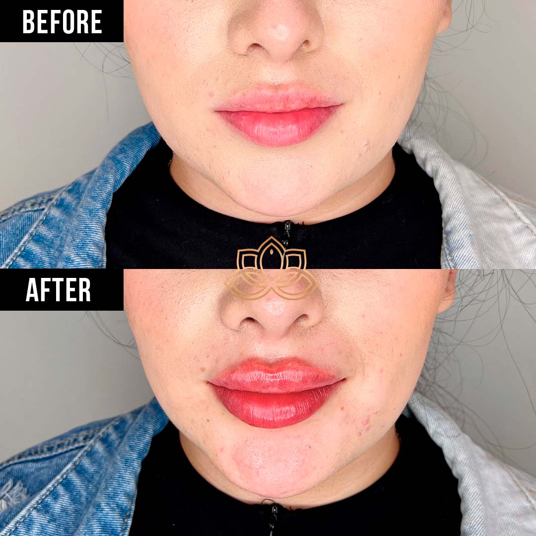 Lip Filler before