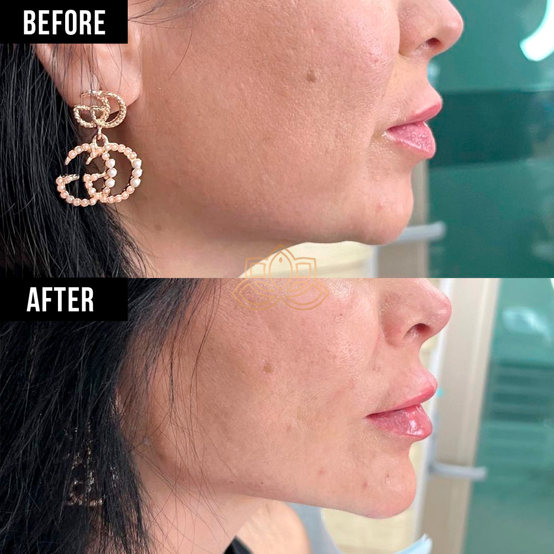 Jaw Contouring before