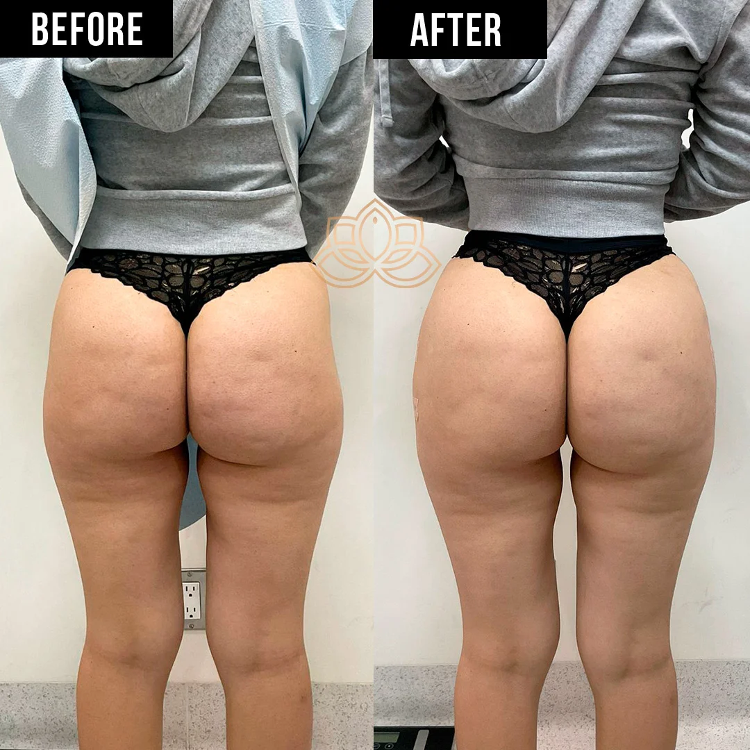 Butt Filler before