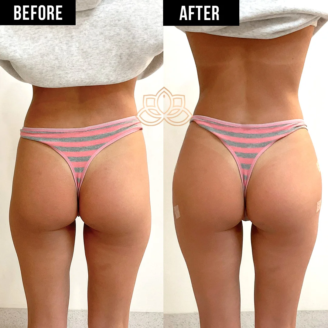 Butt Filler after