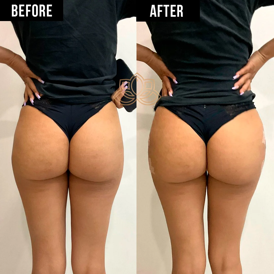 Butt Filler after