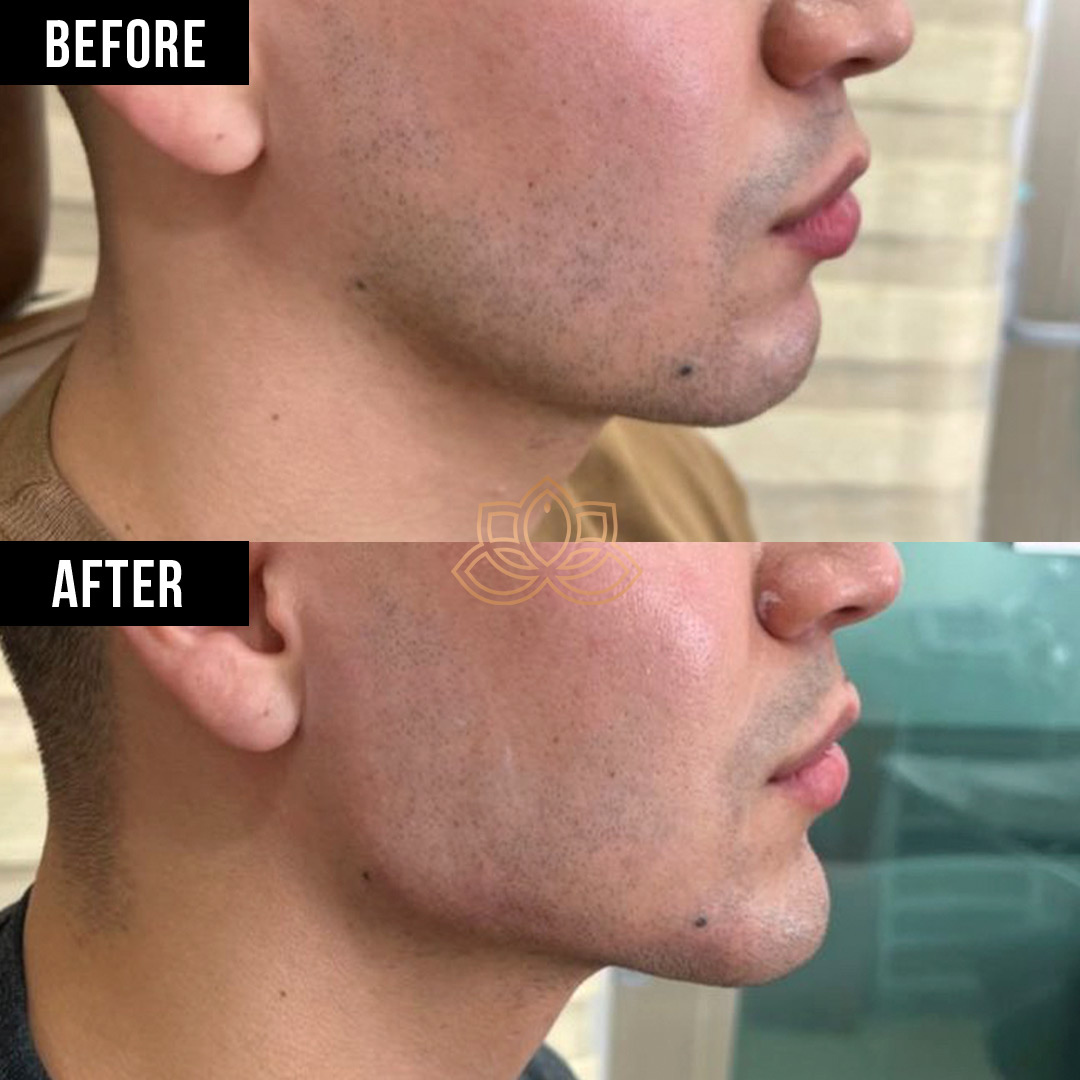 Jaw Contouring after