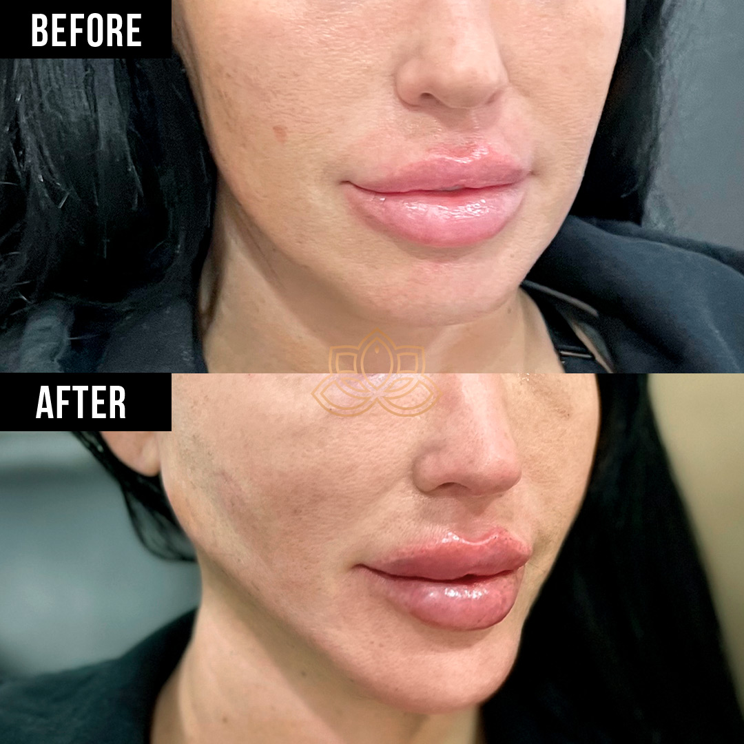 Lip Filler after