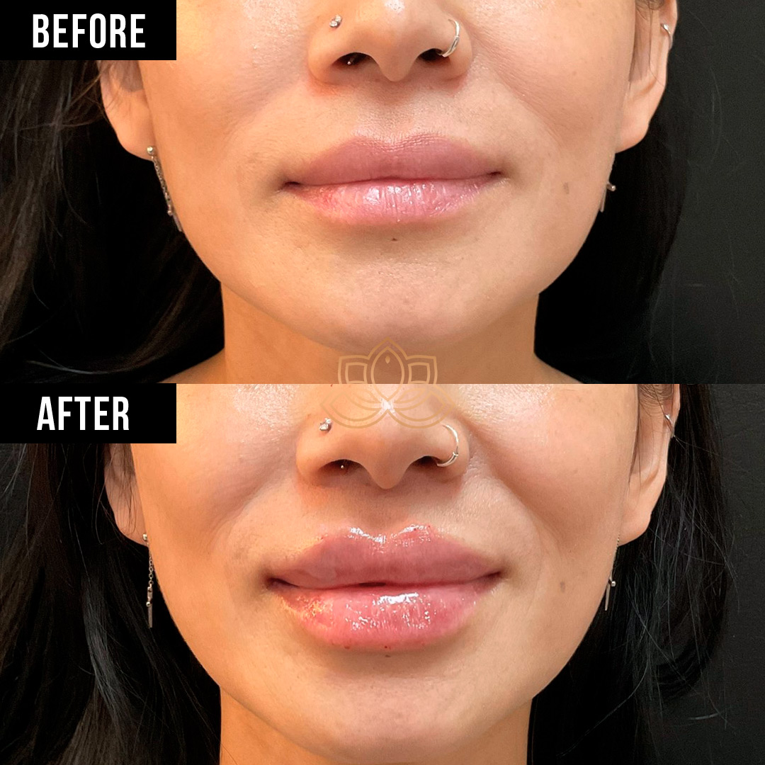 Lip Filler before