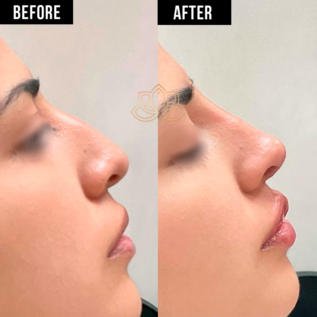 Nose Filler before