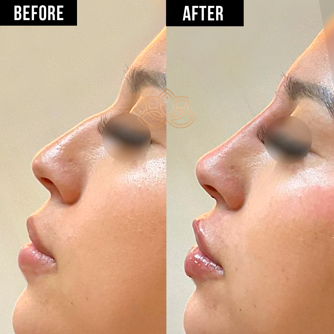 Nose Filler after