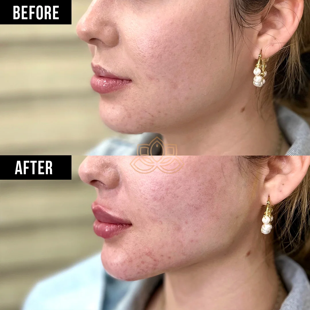 Jaw Contouring before
