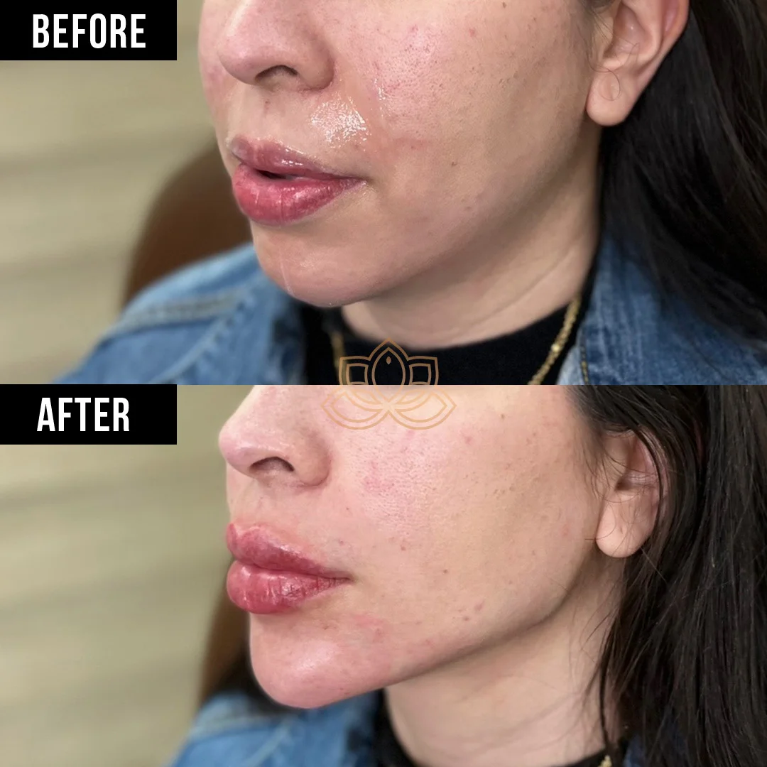 Jaw Contouring after