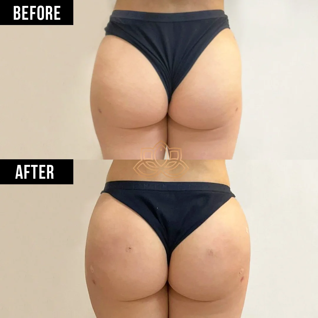 Butt Filler before