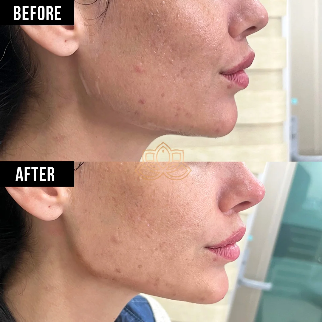 Jaw Contouring before