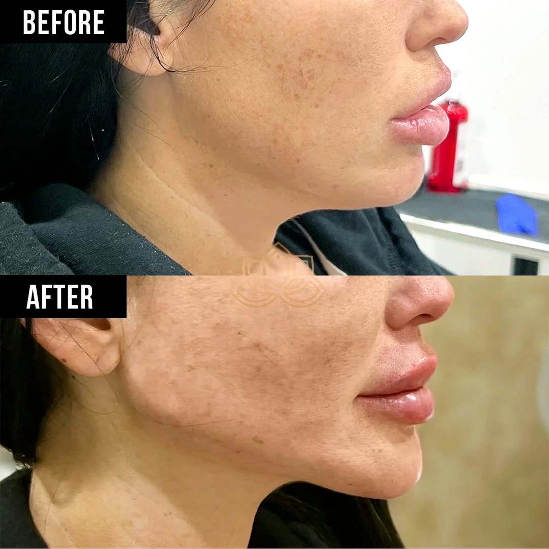 Jaw Contouring after