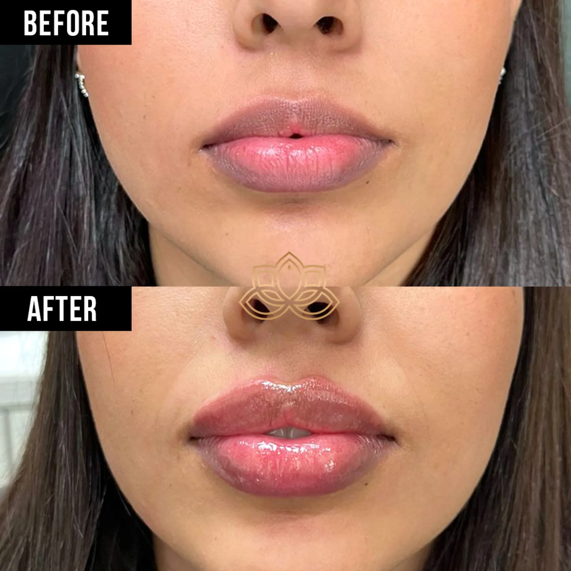 Lip Filler after