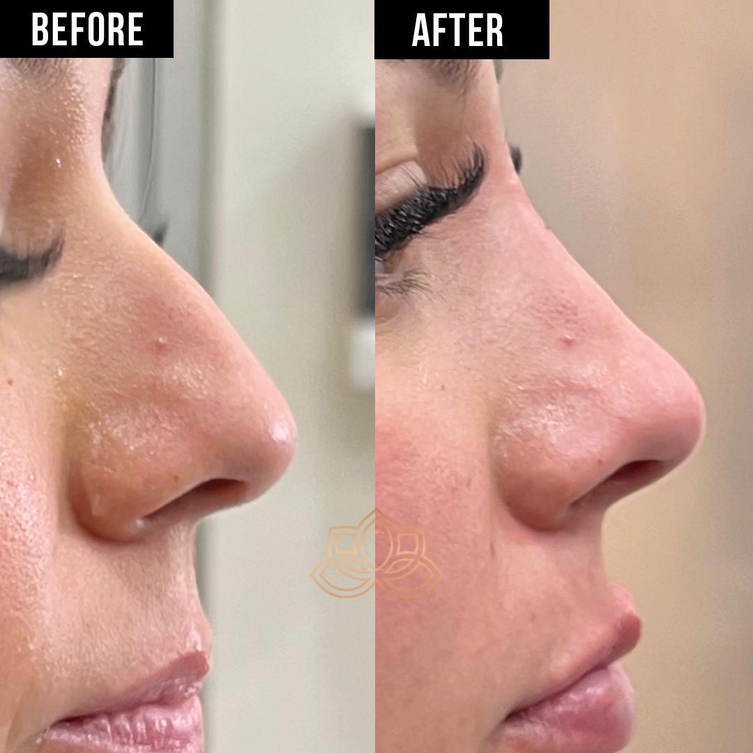 Nose Filler after