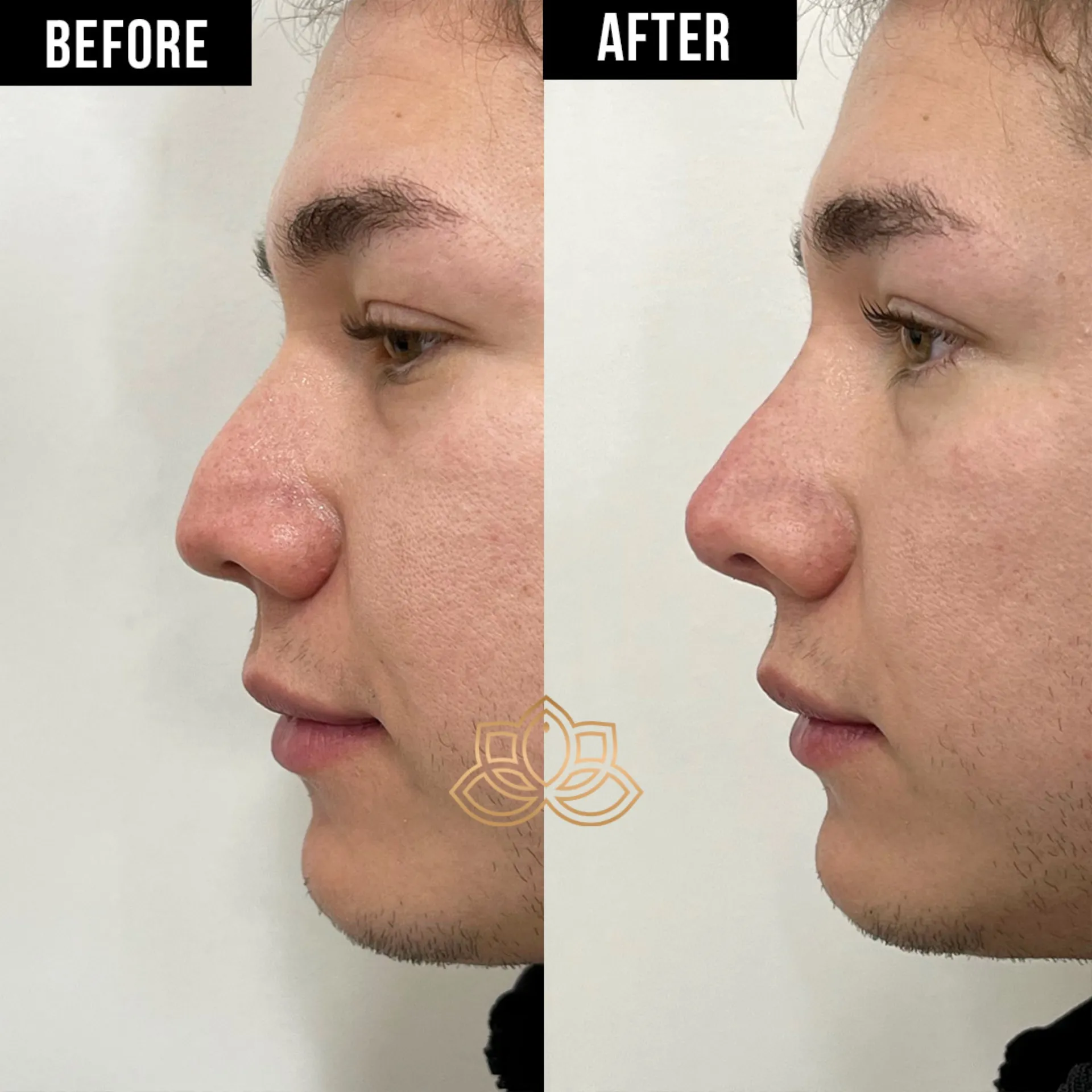 Nose Filler before