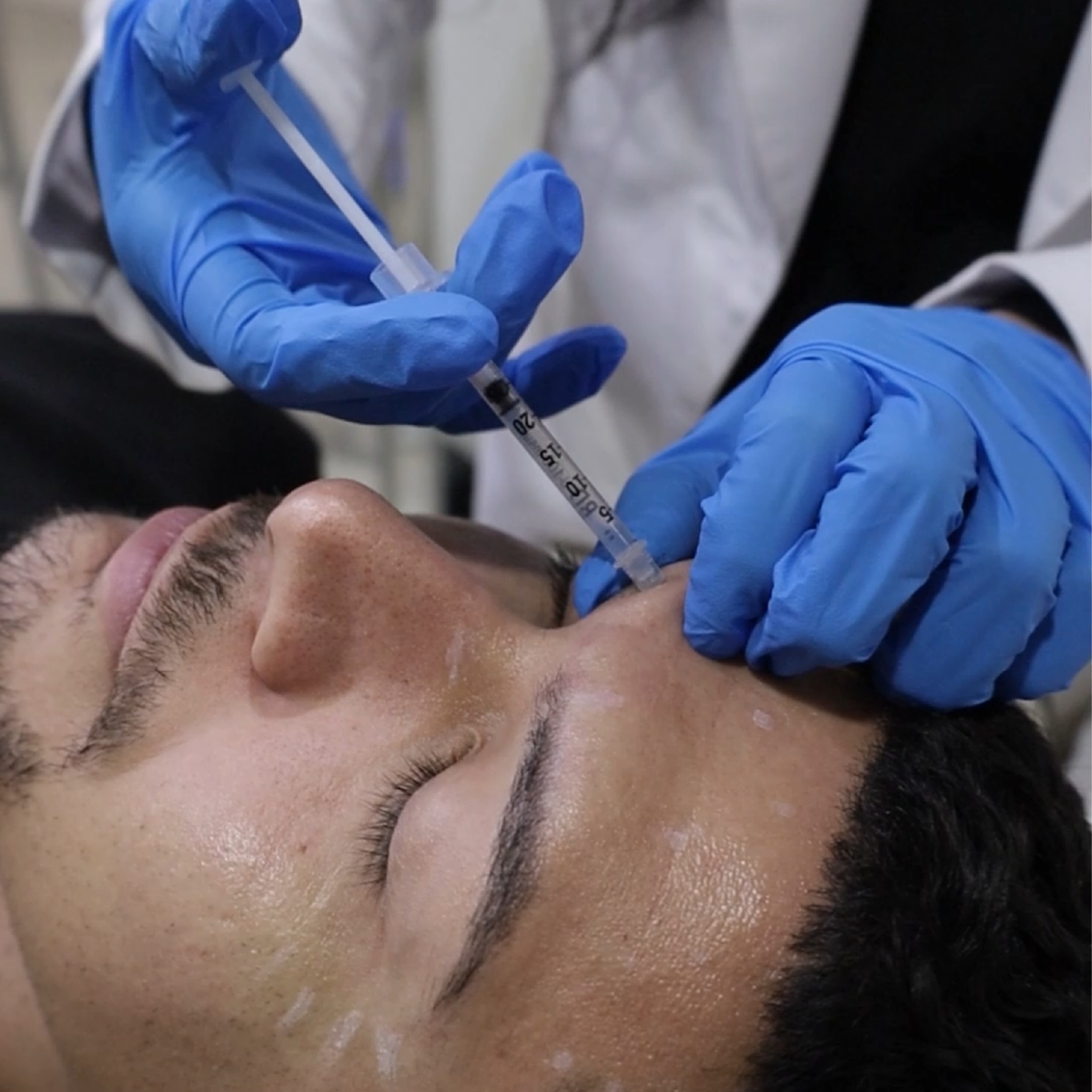 Facebalance facial harmonization treatment at Vive Med Spa Tijuana - hyaluronic acid filler protocol