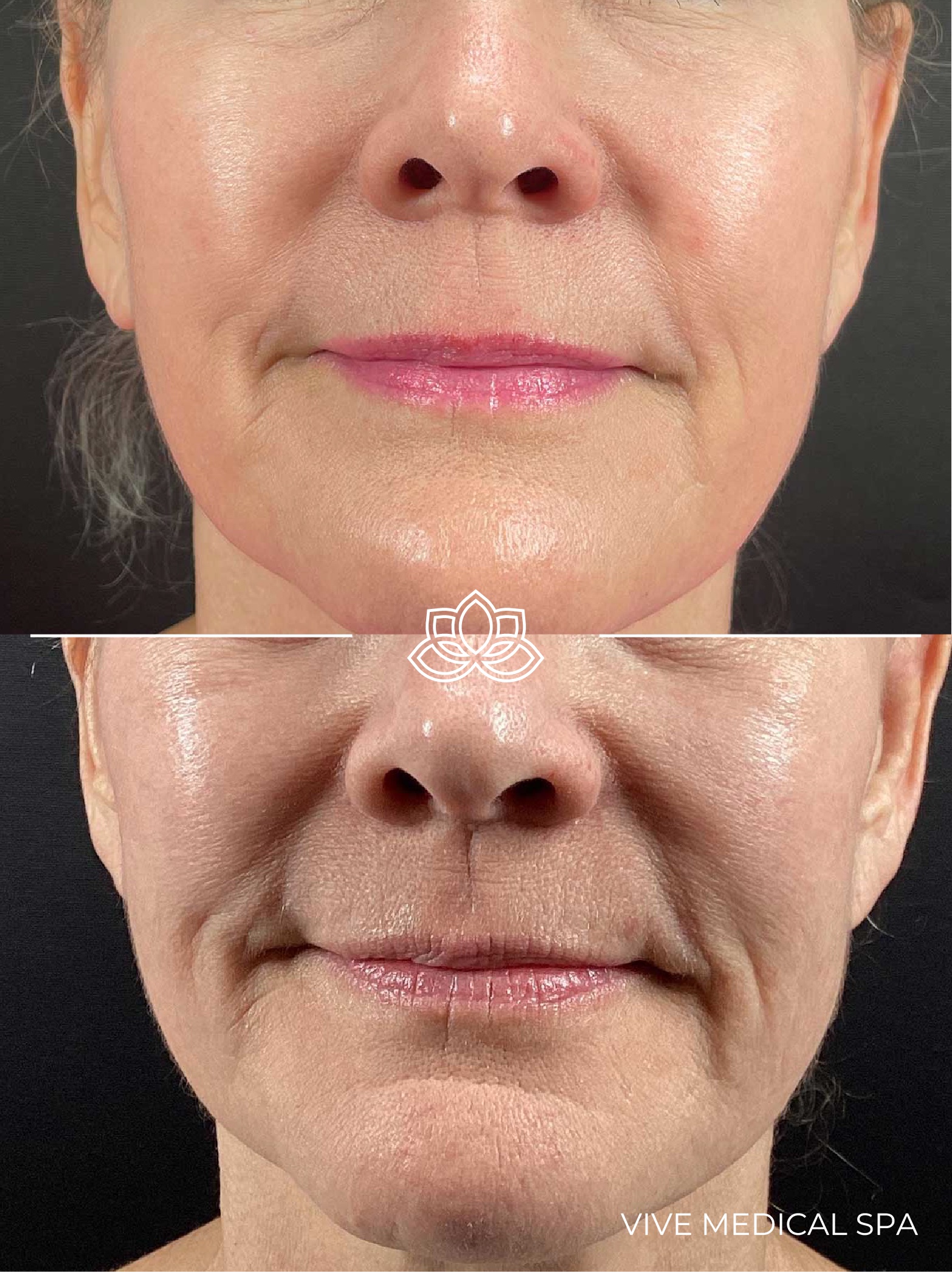 Morpheus8 Burst Deep treatment in Tijuana, Mexico - Multi-level body remodeling at Vive Med Spa