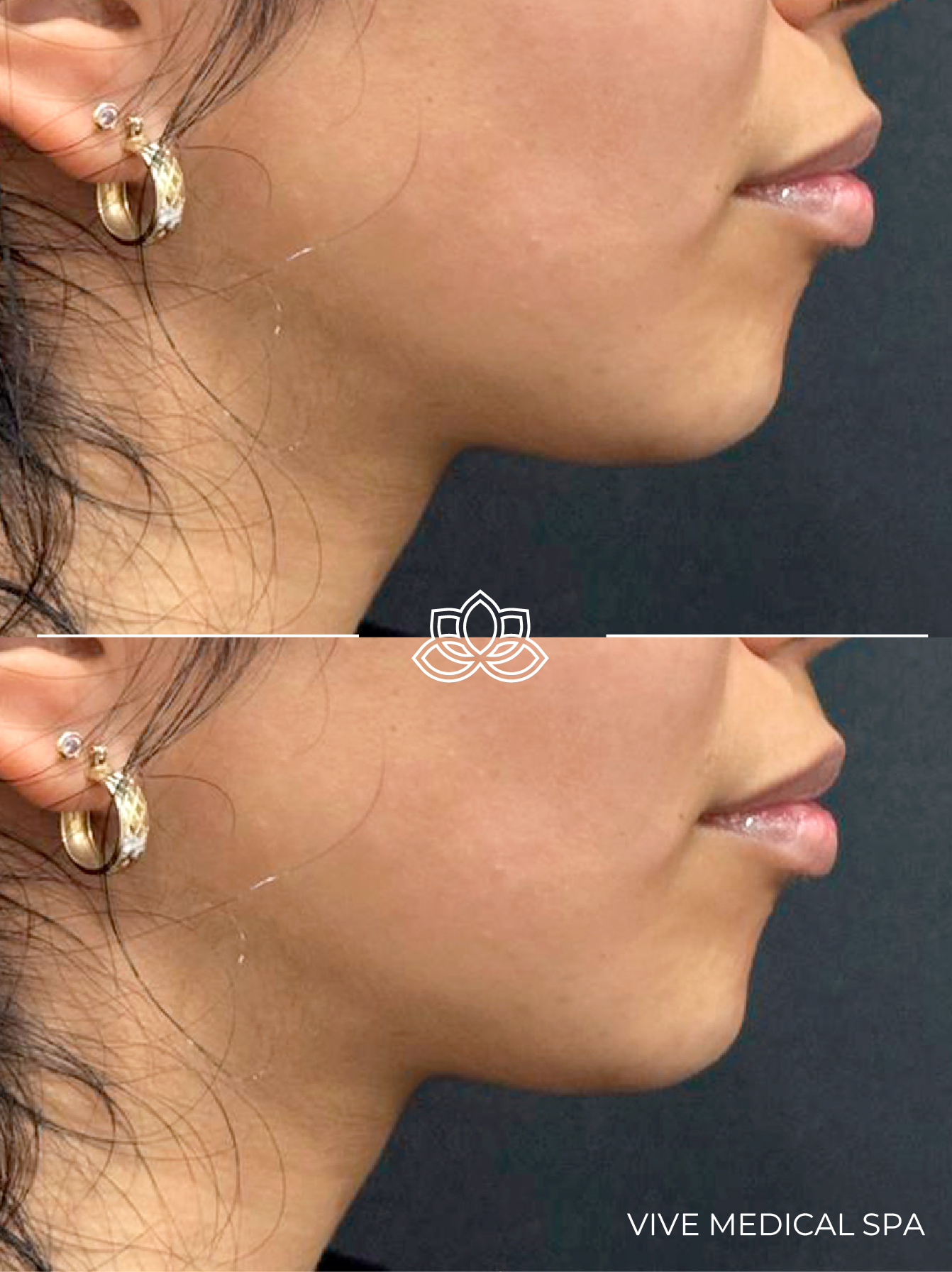 FaceTite Inmode minimally invasive RF facial lifting device