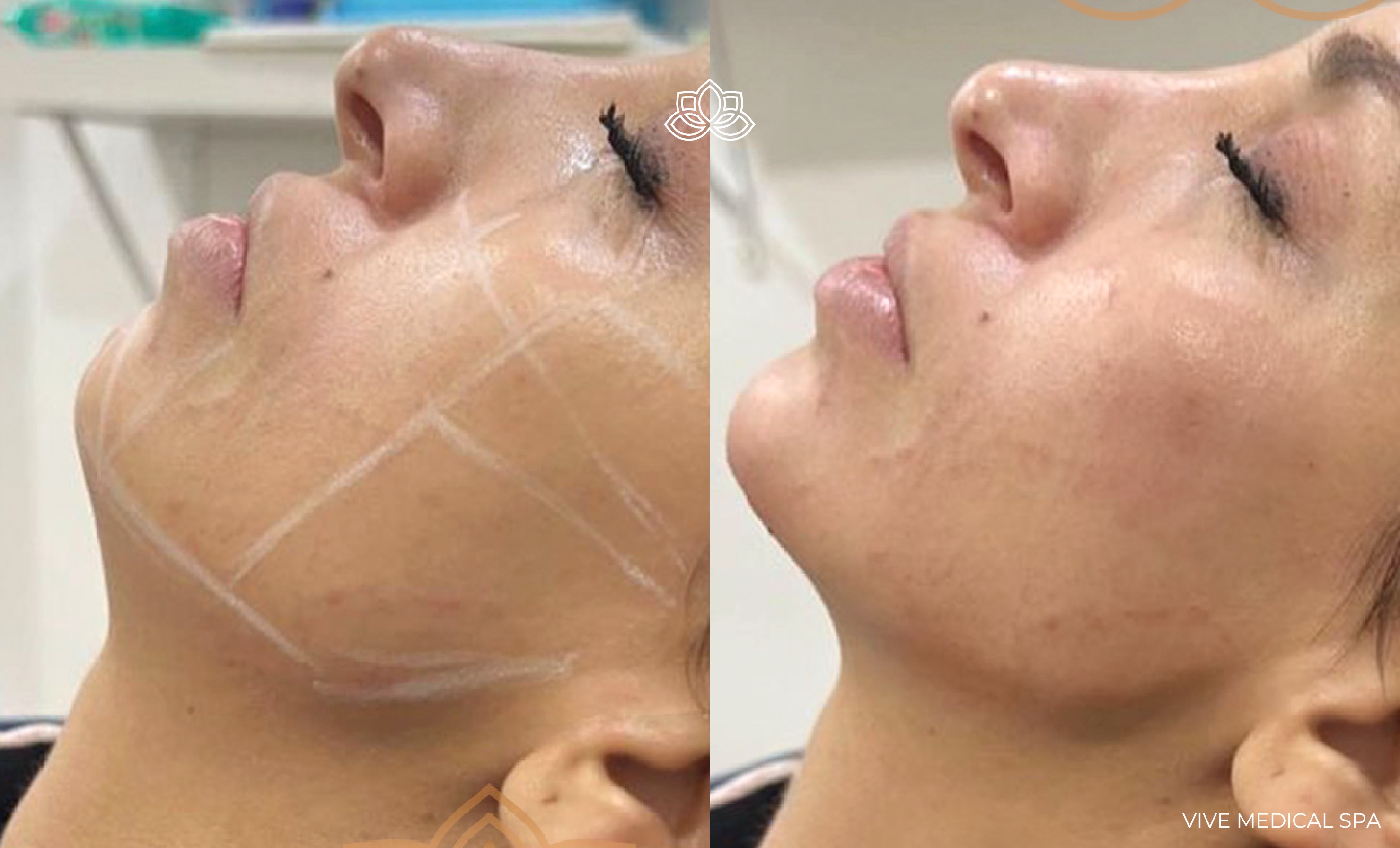 Chin augmentation procedure at Vive Med Spa Tijuana