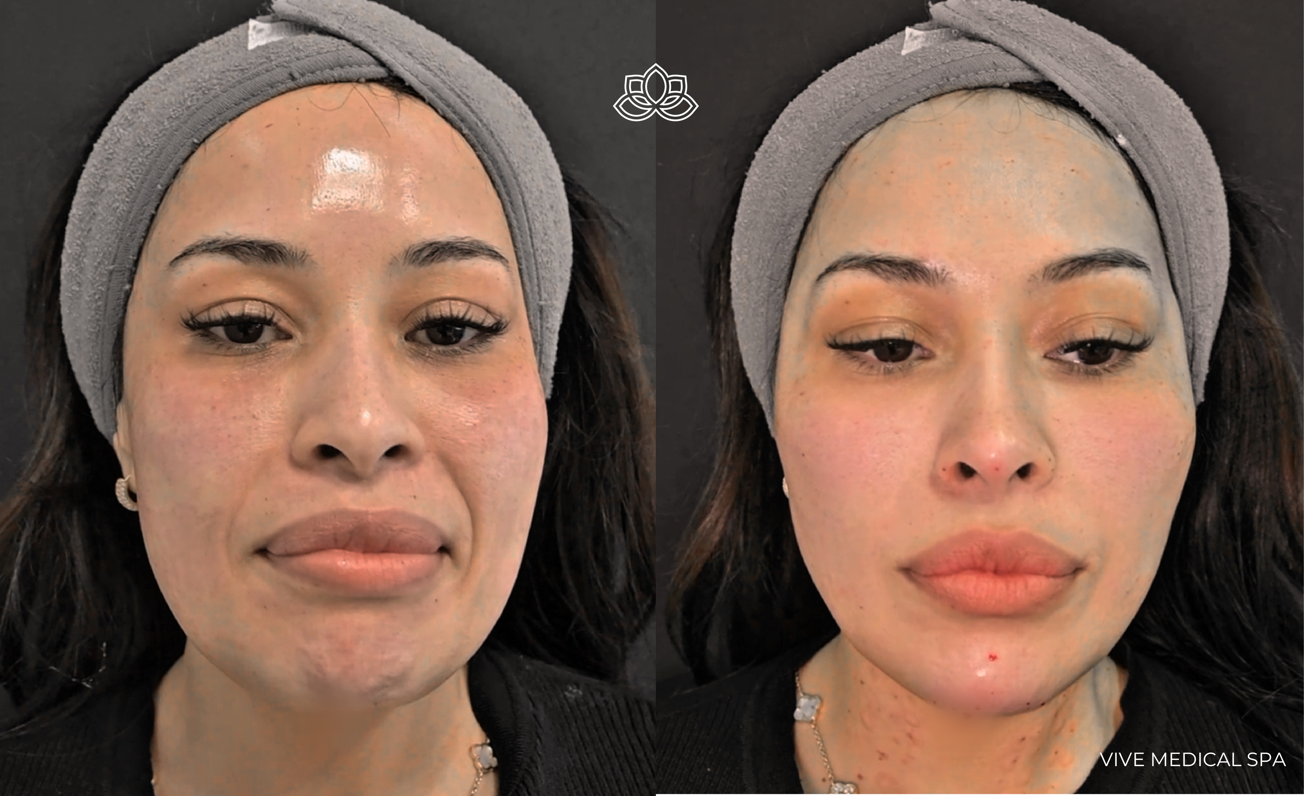 Endymed Pro treatment in Tijuana, Mexico - Multi-source radiofrequency skin tightening at Vive Med Spa