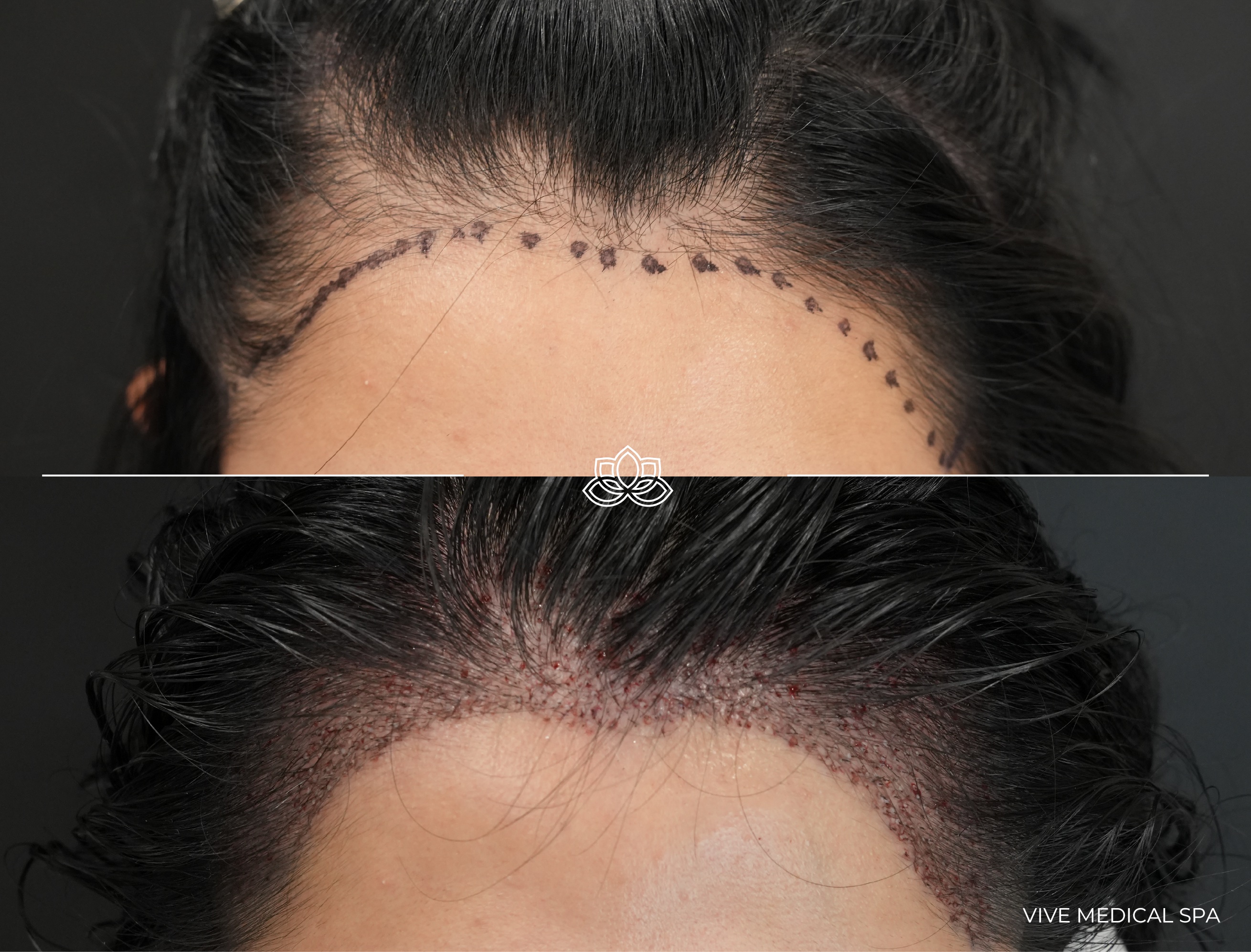 Board-certified surgeon at Vive Med Spa performing FUE transplant