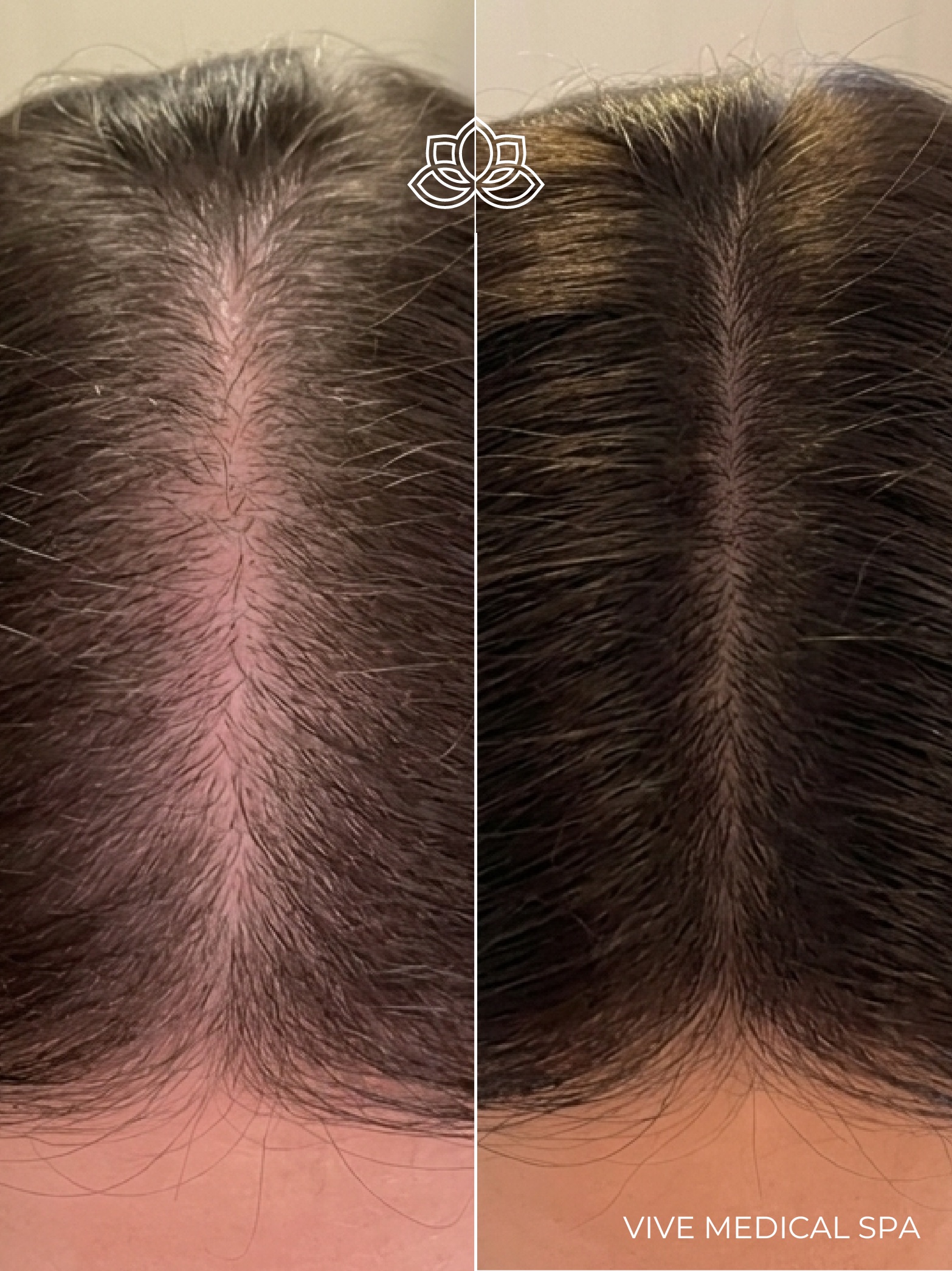 Hair Mesotherapy at Vive Medical Spa Tijuana